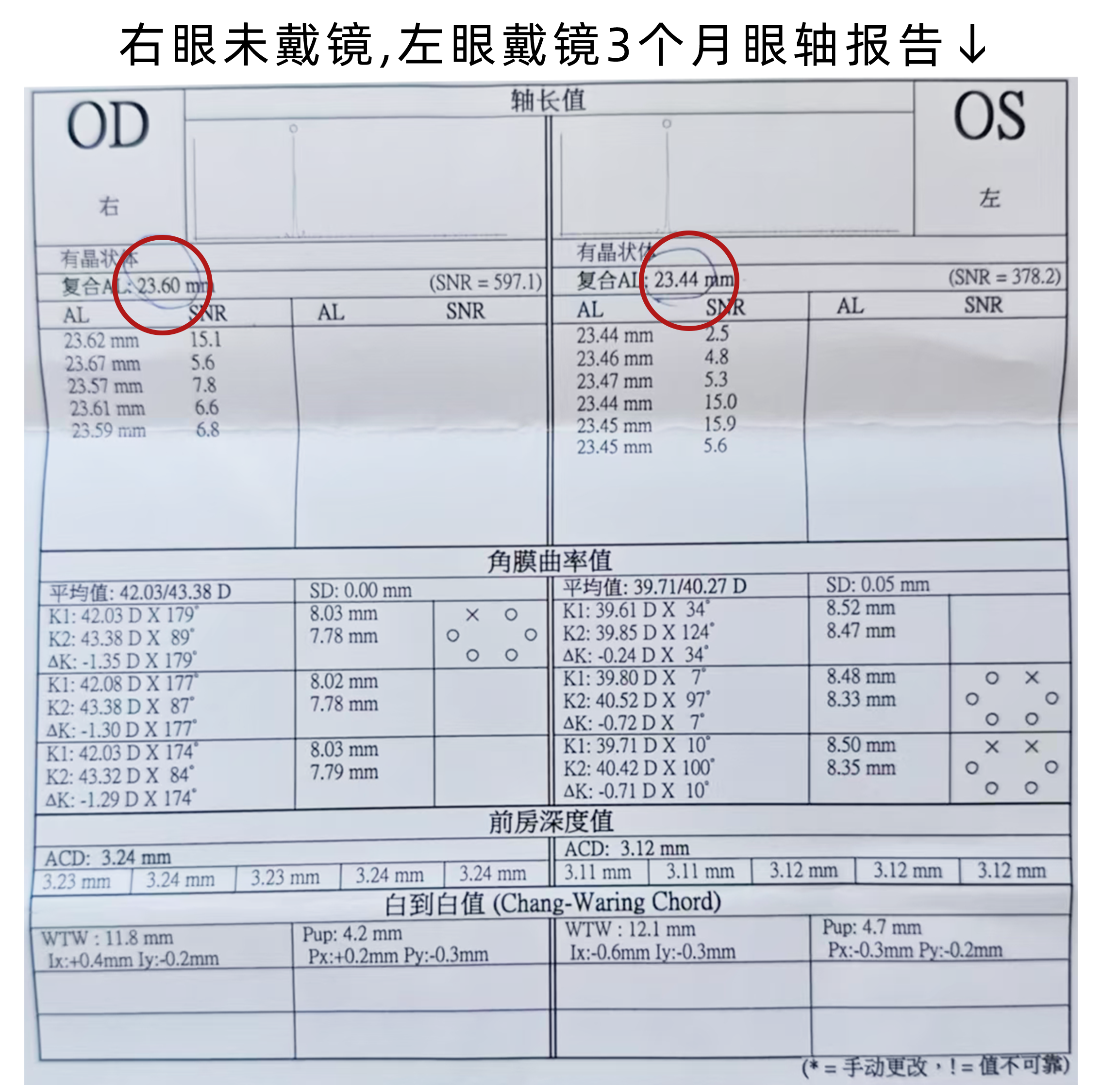 02.右眼不戴左眼戴3个月