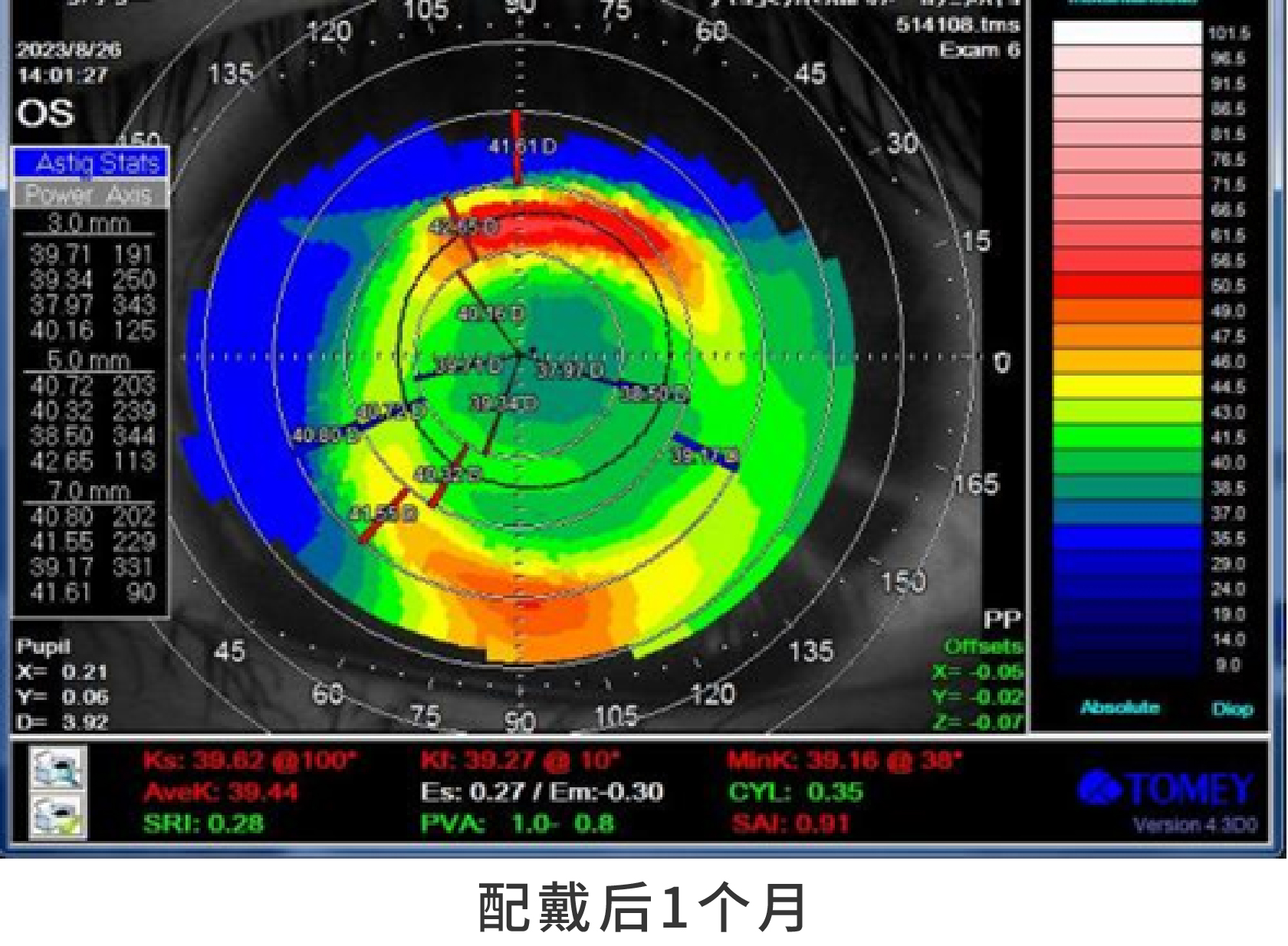 08.配戴1个月