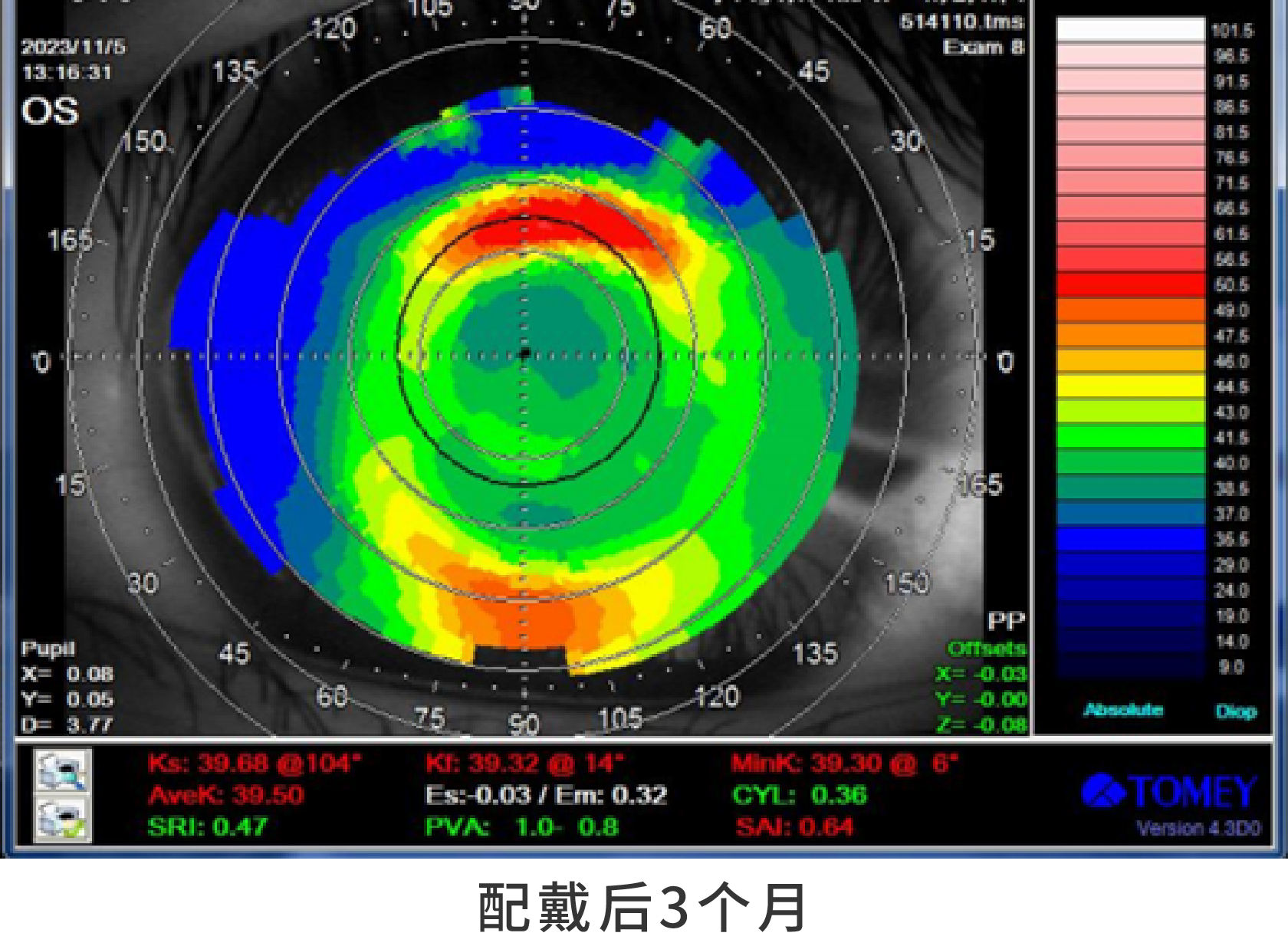 09.配戴3个月